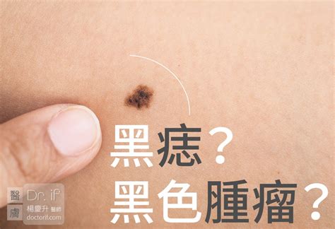 陰囊 痣|陰囊長痣怎麼辦？3招應對